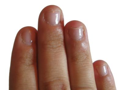 Right hand, March 9 2009 Fingernail Progress